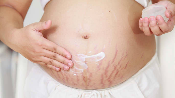 Read more about the article Hate Stretch Marks? Let’s Get Rid of Those Annoying Stripes